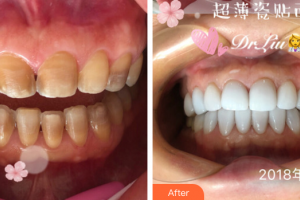 珠海拜博口腔醫(yī)院廖越奇整形價(jià)格表附瓷貼面案例展示