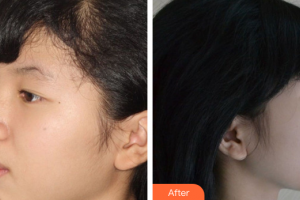 珠海拜博口腔醫(yī)院解淼整形價(jià)格表附自鎖矯正案例展示