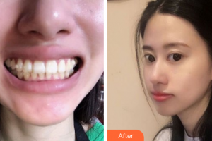 珠海拜博口腔醫(yī)院程峰整形價(jià)格表附隱形矯正案例展示