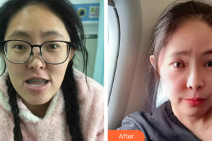 珠海拜博口腔醫(yī)院趙陽(yáng)整形價(jià)格表附金屬矯正案例展示