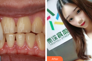 珠海優(yōu)里卡齒科門(mén)診部畢春英整形價(jià)格表附牙齒隱形矯正案例展示