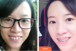 珠海六合口腔門(mén)診部黎文明整形價(jià)格表附自鎖托槽矯正案例展示