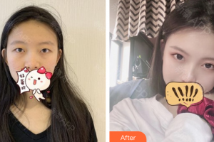 遵義醫(yī)科大學(xué)第五附屬（珠海）醫(yī)院整形燒傷手外科陳世玖整形價(jià)格表附全切雙眼皮案例展示