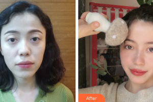 珠海雅媛醫(yī)療美容門(mén)診部張志欣整形價(jià)格表附眼部綜合案例展示