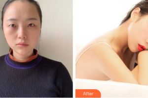 珠海雅媛醫(yī)療美容門(mén)診部張嘯整形價(jià)格表附眼部綜合案例展示