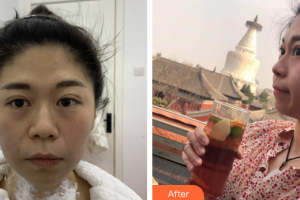 珠海藝星（原仁愛(ài)）醫(yī)療美容門(mén)診部羅家寧主診醫(yī)師整形價(jià)格表附熱瑪吉抗衰案例展示