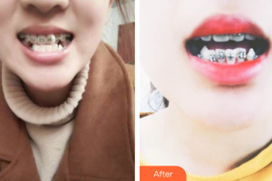 珠海美南華醫(yī)療美容醫(yī)院嚴(yán)擁整形價(jià)格表附金屬矯正案例展示