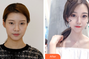 汕頭泛美泓涵醫(yī)療美容診所孫學梅整形價格表附多方面部埋線提升案例展示