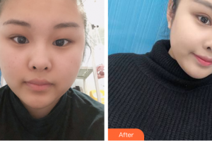 汕頭大學醫(yī)學院第一附屬醫(yī)院醫(yī)學美容中心紀影暢整形價格表附雙眼皮案例展示