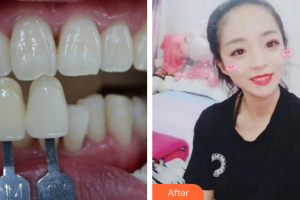 汕頭曙光整形美容醫(yī)院鄭重整形價格表附冷光美白案例展示