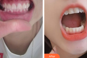 汕頭曙光整形美容醫(yī)院麻偉達整形價格表附國產(chǎn)直絲弓矯正案例展示