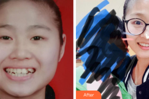 汕頭名流整形美容醫(yī)院麻維達整形價格表附金屬托槽案例展示