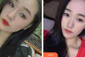 汕頭大學醫(yī)學院第一附屬醫(yī)院醫(yī)學美容中心許宏權整形價格表附光子嫩膚案例展示