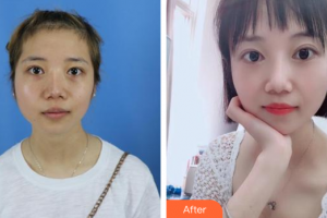 汕頭大學(xué)醫(yī)學(xué)院第一附屬醫(yī)院醫(yī)學(xué)美容中心蔡湘娜整形價格表附激光祛斑案例展示