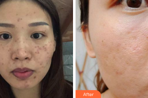 汕頭大學(xué)醫(yī)學(xué)院第二附屬醫(yī)院燒傷整形科唐世杰整形價格表附去痘印痘坑案例展示