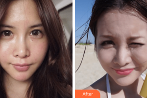 汕頭大學(xué)醫(yī)學(xué)院第二附屬醫(yī)院燒傷整形科李海紅整形價格表附祛斑案例展示