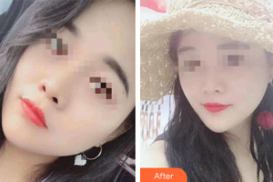 汕頭大學(xué)醫(yī)學(xué)院第二附屬醫(yī)院燒傷整形科楊旅軍整形價格表附超微小氣泡案例展示