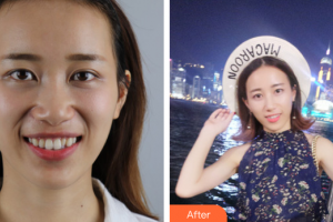 汕頭邱寧口腔診所許瑞芬整形價格表附全隱形牙齒矯正案例展示