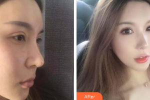 佛山曙光金子醫(yī)學(xué)美容醫(yī)院甘國端整形價格表附光子嫩膚案例展示