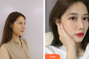 佛山曙光金子醫(yī)學(xué)美容醫(yī)院鄭永健整形價格表附玻尿酸精華導(dǎo)入案例展示