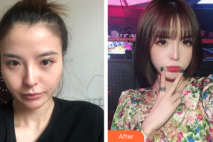 佛山曙光金子醫(yī)學(xué)美容醫(yī)院劉洲尉整形價格表附面部吸脂案例展示