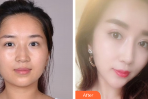 佛山曙光金子醫(yī)學(xué)美容醫(yī)院沈荷云整形價格表附美白嫩膚案例展示