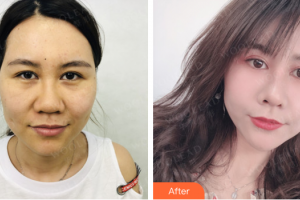 佛山曙光金子醫(yī)學(xué)美容醫(yī)院邱會銀整形價格表附超激光美膚案例展示