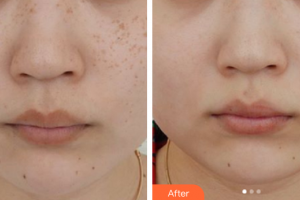 佛山曙光金子醫(yī)學(xué)美容醫(yī)院甘廣蓮整形價格表附激光祛除雀斑案例展示