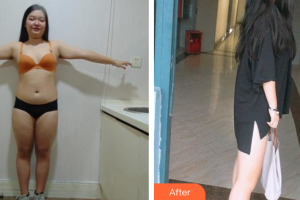 佛山東方女子醫(yī)院整形美容中心姜政輝整形價格表附水動力吸脂案例展示