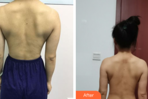 佛山東方女子醫(yī)院整形美容中心林淵慧整形價格表附手臂吸脂案例展示