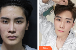 佛山瑞芙臣夢露醫(yī)學(xué)整形美容醫(yī)院陸小湖整形價格表附超激光美膚祛斑案例展示