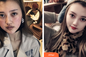 佛山蘇李秀英醫(yī)院激光整形科王晶整形價格表附果酸換膚案例展示