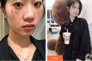 佛山市第一人民醫(yī)院醫(yī)學(xué)美容科劉必來整形價格表附祛斑案例展示