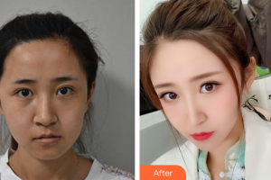 佛山市第一人民醫(yī)院醫(yī)學(xué)美容科楊榮梅整形價格表附二氧化碳點痣案例展示