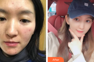 佛山市南海人民醫(yī)院燒傷整形科何冬誠整形價格表附微針美膚案例展示