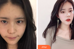 佛山市第二人民醫(yī)院醫(yī)學(xué)整形美容科張旭霞整形價格表附光子嫩膚案例展示