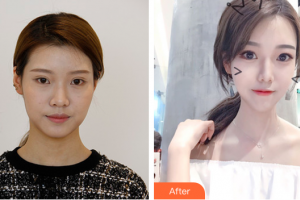 佛山黛顏人醫(yī)療美容門診部胡斌整形價(jià)格表附多方面部埋線提升案例展示