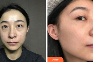 佛山南海區(qū)第二人民醫(yī)院燒傷整形科陸顯斌整形價(jià)格表附激光美膚激光祛斑案例展示