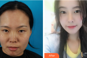 佛山凱潤(rùn)婷整形美容醫(yī)院卞鵬飛整形價(jià)格表附自體脂肪填充案例展示