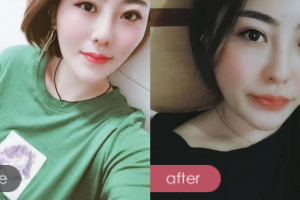 佛山曙光金子醫(yī)學(xué)美容醫(yī)院劉偉忠整形價(jià)格表附除腋臭案例展示