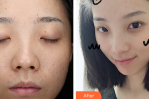 佛山壹加壹瑪麗婭整形美容醫(yī)院鐘文華整形價(jià)格表附果酸煥膚案例展示