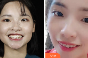 佛山曙光金子醫(yī)學(xué)美容醫(yī)院劉曉勤整形價(jià)格表附牙齒矯正案例展示