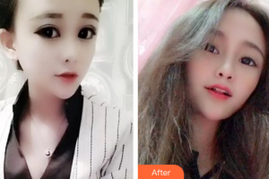 佛山壹加壹瑪麗婭整形美容醫(yī)院許凡平整形價(jià)格表附皓齒美白案例展示