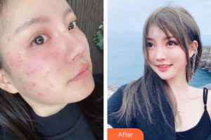 佛山曙光金子醫(yī)學(xué)美容醫(yī)院張芝才整形價(jià)格表附激光祛斑案例展示