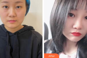 佛山美嘉美醫(yī)療美容門診部樸善在整形價(jià)格表附埋線雙眼皮案例展示