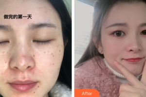 佛山貝爾美醫(yī)學(xué)美容整形醫(yī)院彭小藍(lán)整形價(jià)格表附蜂巢激光美膚案例展示