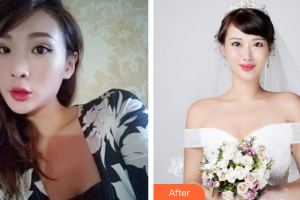 佛山廣美醫(yī)療美容門診部羅雄鵬整形價(jià)格表附鼻部手術(shù)案例展示