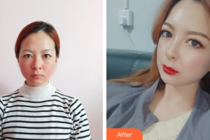 佛山廣美醫(yī)療美容門診部孫凱整形價(jià)格表附熱瑪吉案例展示