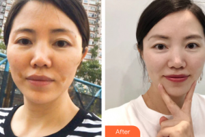 佛山顏植醫(yī)療美容門診部李莉整形價(jià)格表附埋線提升案例展示