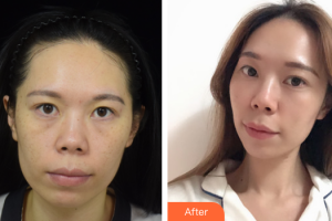 佛山廣美醫(yī)療美容門診部楊群鳳整形價(jià)格表附熱拉提緊致除皺案例展示